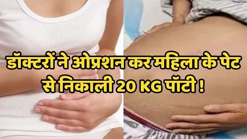डॉक्टरों ने ओप्रशन कर महिला के पेट से निकाली 20 kg पॉटी !